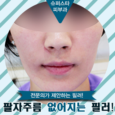 팔자주름 없애주는 필러! 구로 슈퍼스타 피부과 필러...